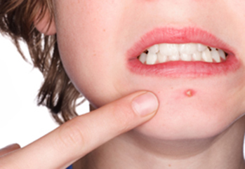 Acne Extractions & Injections