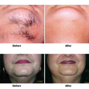 Laser hair removal in charlotte nc before and after pictures
