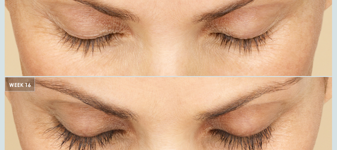 Latisse Charlotte Beforeafter 2