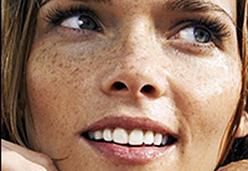 Sun Spot And Age Spot Removal