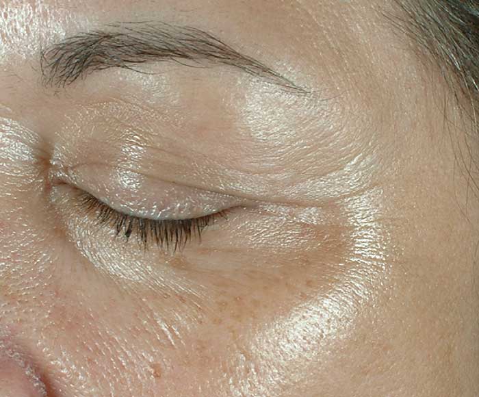 Before Obagi ELASTIderm